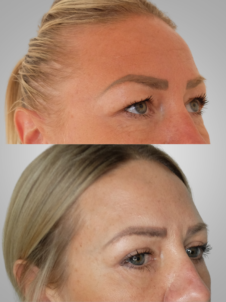 blépharoplastie